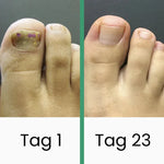 PedKlar® | LLLT-Nagelpilztherapie