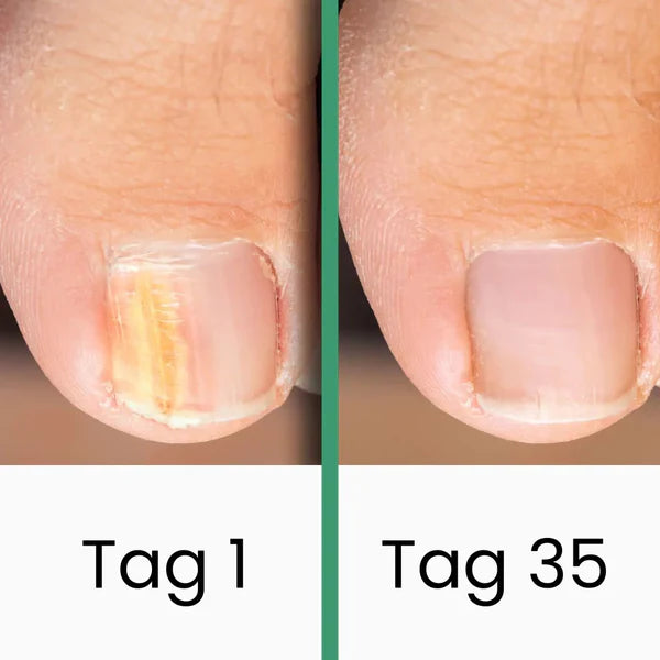 PedKlar® | LLLT-Nagelpilztherapie