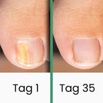 PedKlar® | LLLT-Nagelpilztherapie