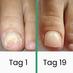 PedKlar® | LLLT-Nagelpilztherapie