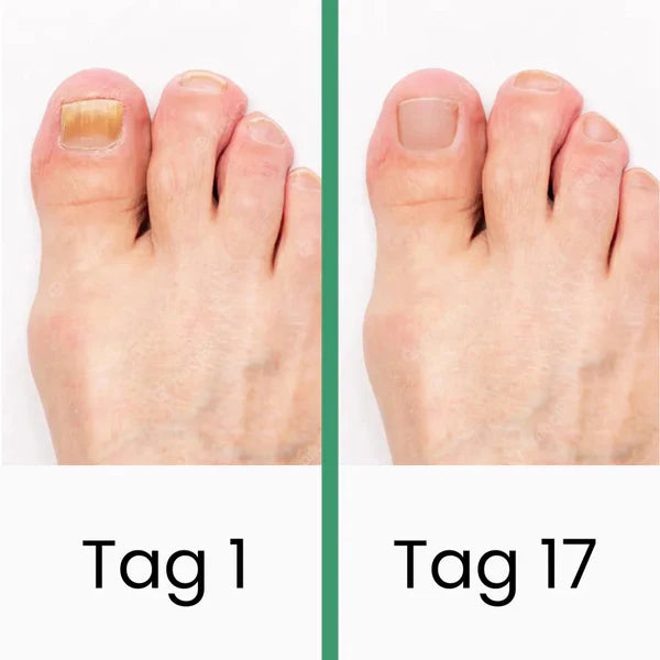 PedKlar® | LLLT-Nagelpilztherapie