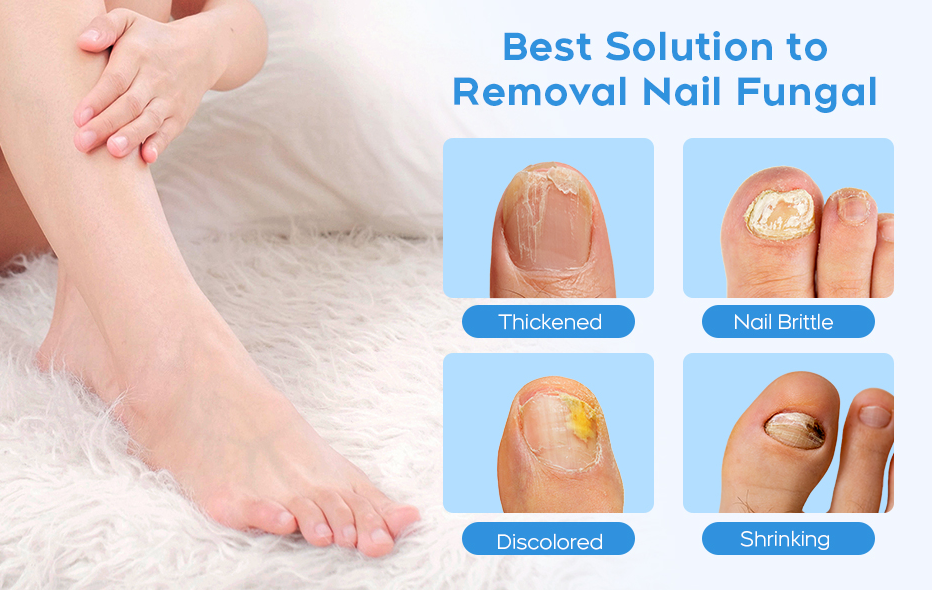 PedKlar® | LLLT-Nagelpilztherapie